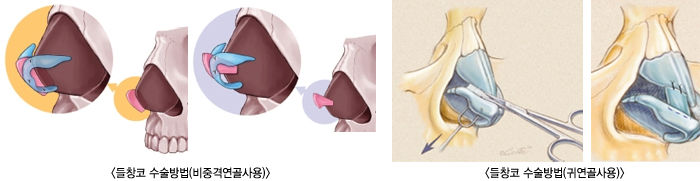 ޺θ 1/޺θ 2